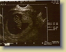 Week9-1st-Ultrasound-13Jul2011 * 800 x 632 * (50KB)